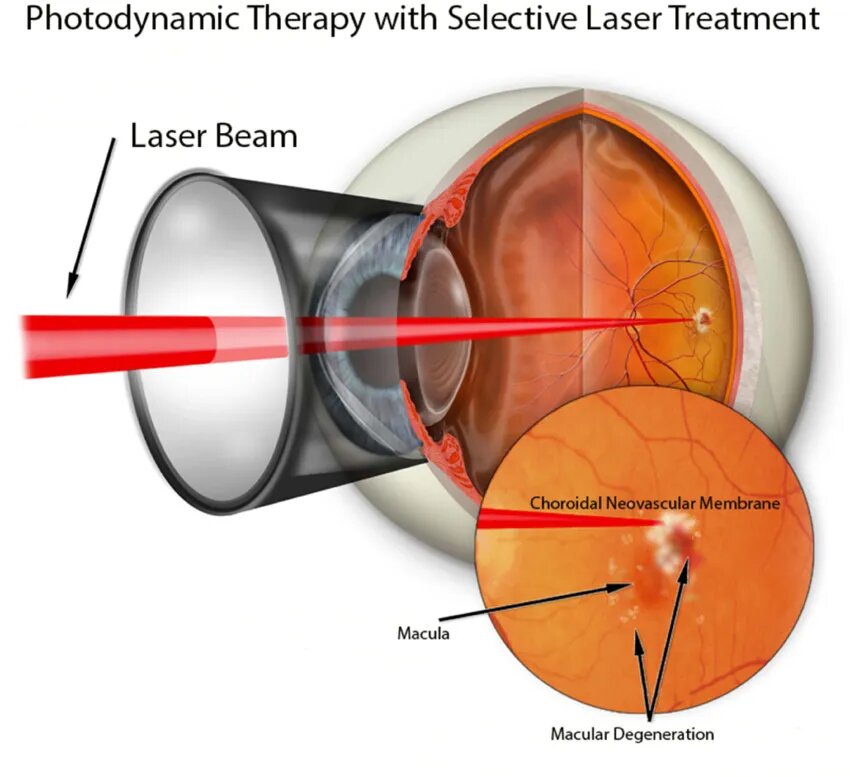 Depci&oacute;n gr&aacute;fica de luz de luz en la membrana neovascular-membrana en la aplicaci&oacute;n